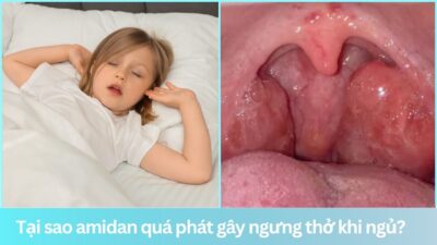 Tại sao amidan quá phát gây ngưng thở khi ngủ?