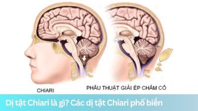 Dị tật Chiari là gì? Phân loại các dị tật Chiari phổ biến
