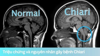 Triệu chứng và nguyên nhân phổ biến gây bệnh Chiari