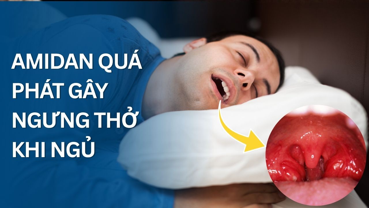 amidan quá phát gây ngưng thở khi ngủ