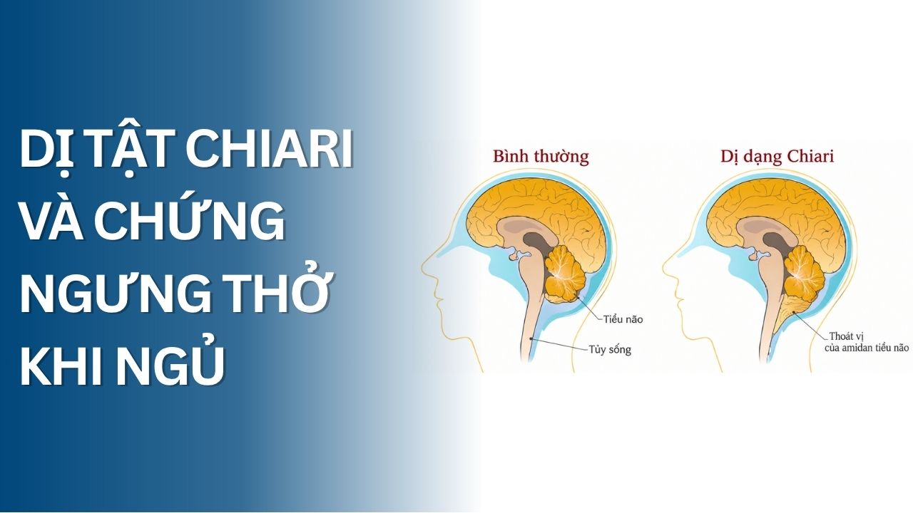Mối quan hệ giữa dị tật Chiari và chứng ngưng thở khi ngủ